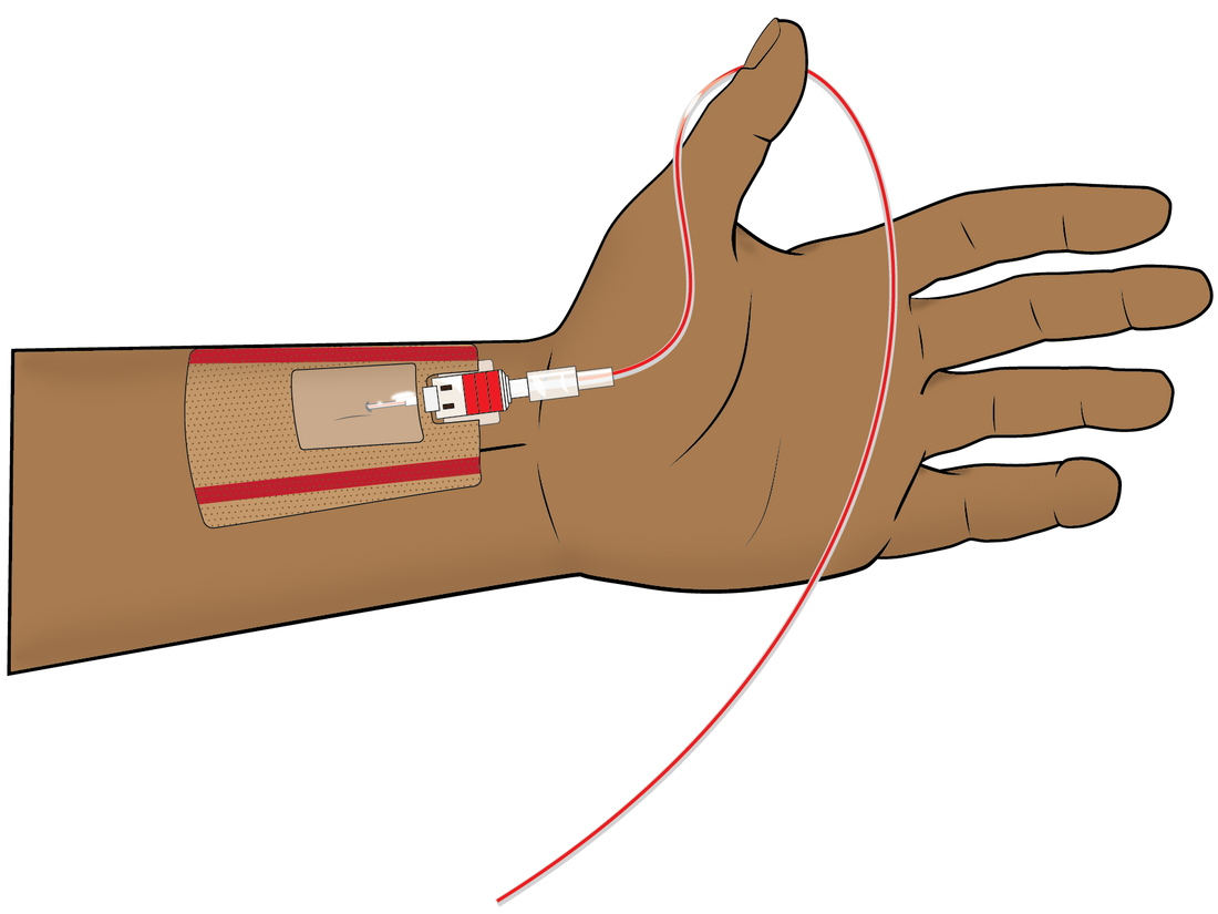 What is an Arterial Line