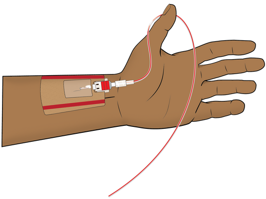 What is an Arterial Line