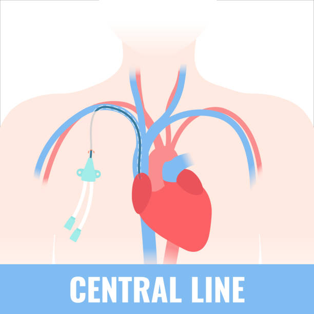 What is a Central Venus Line (CVP)